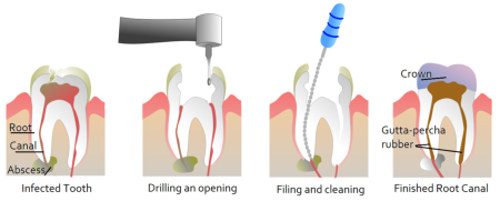 Root Canals - Endodontics | Hwy 30 Family Dental Clinic ...