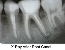 root-canal-procedure